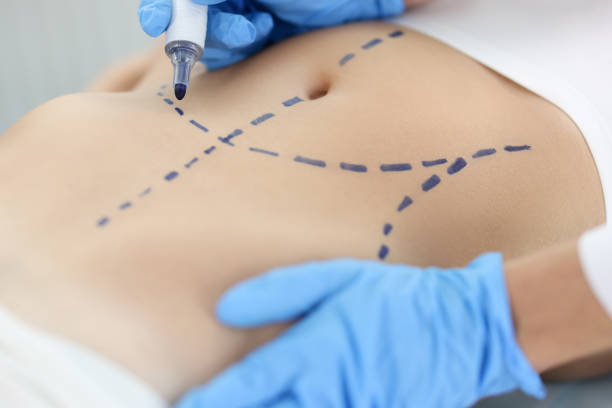 Your Journey to a Sculpted Body Starts with Liposuction in Abu Dhabi